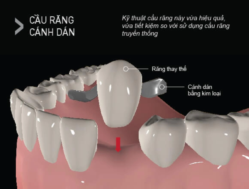 Cầu răng sứ cánh dán (Nguồn: Sưu tầm)